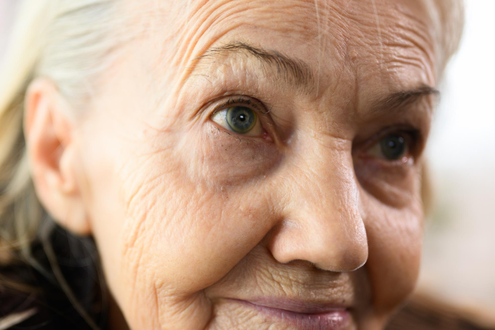 Upper Blepharoplasty