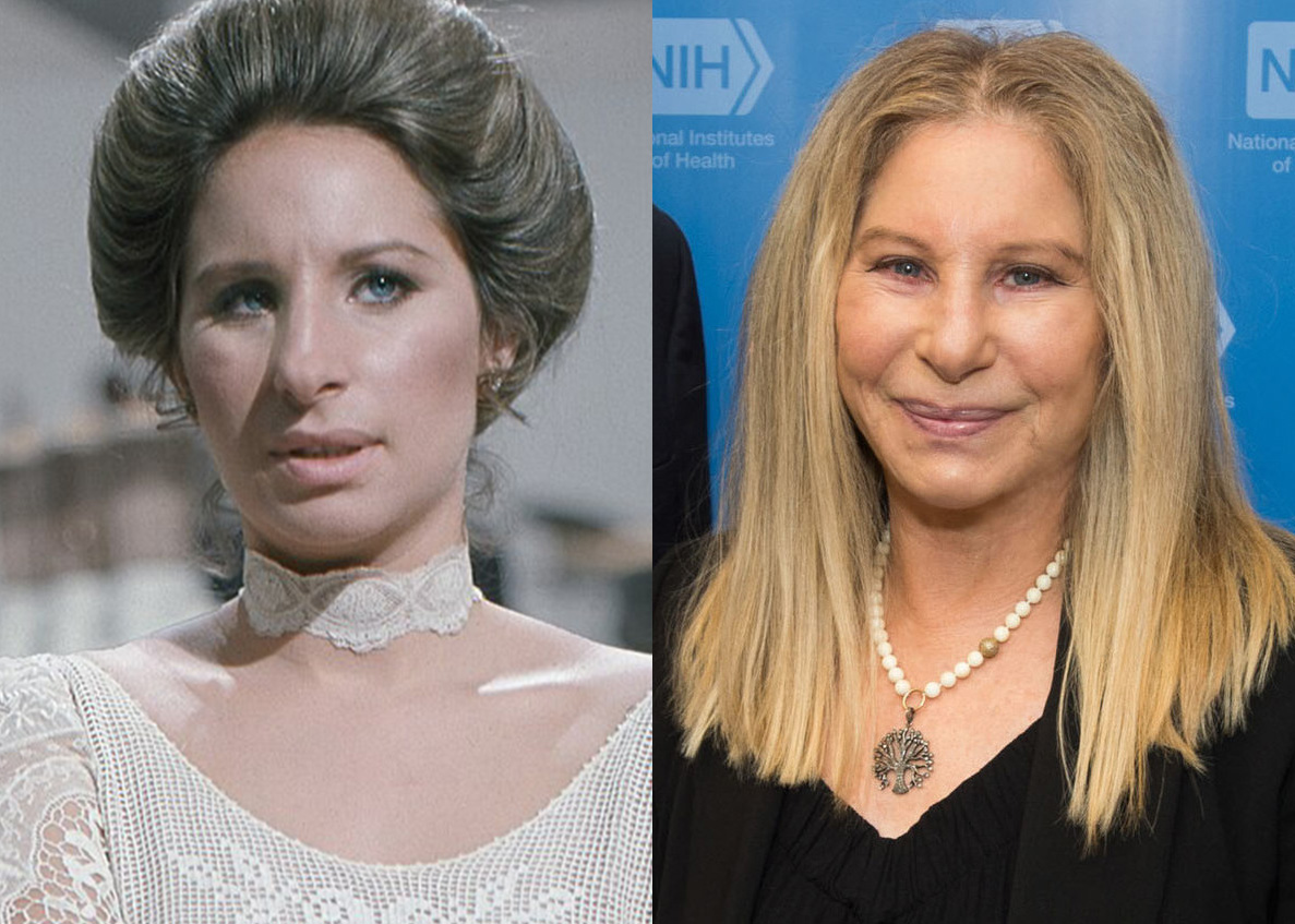 Barbra Streisand Facelift: How The Star Maintains Her Iconic Look